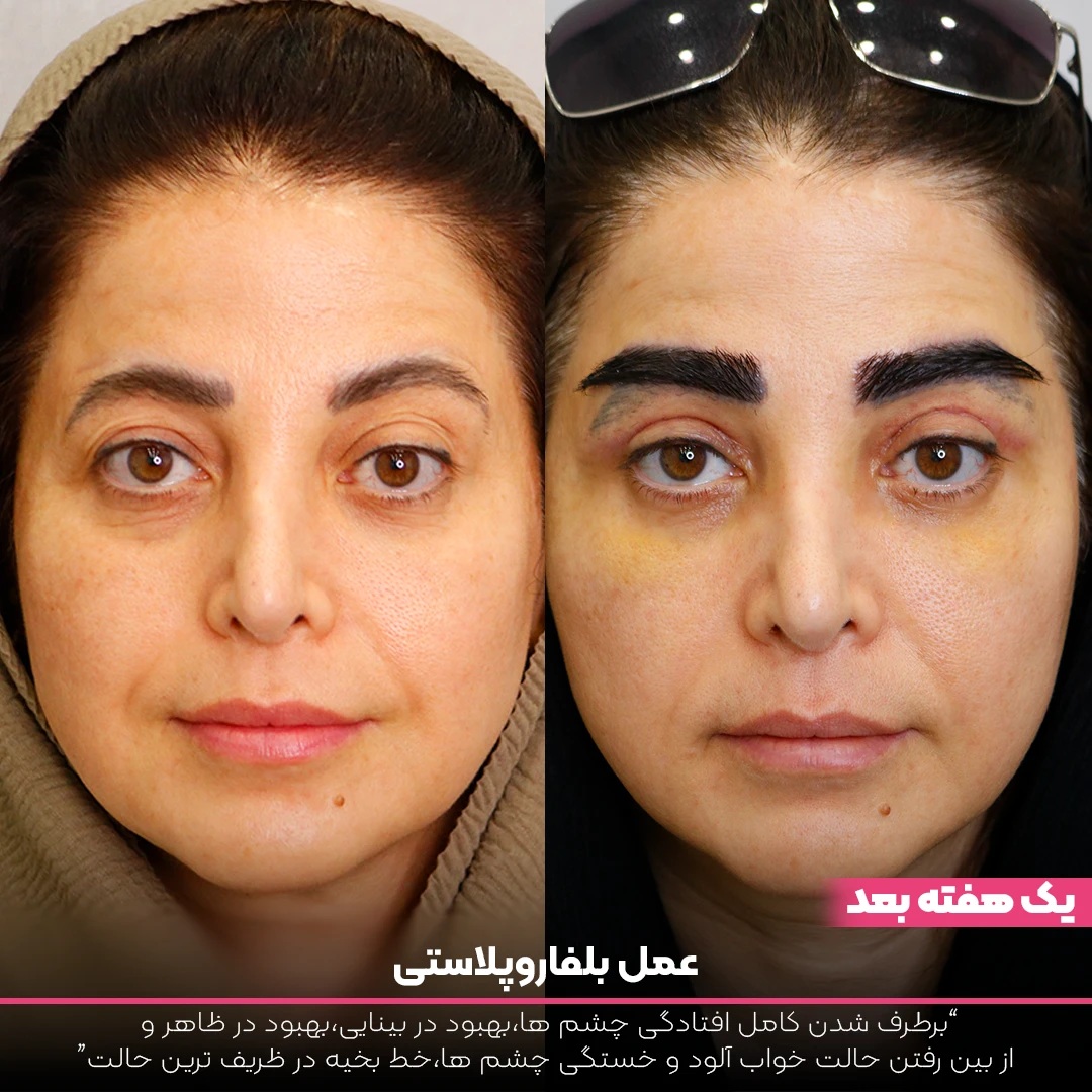 عکس قبل و بعد بلفاروپلاستی خانم