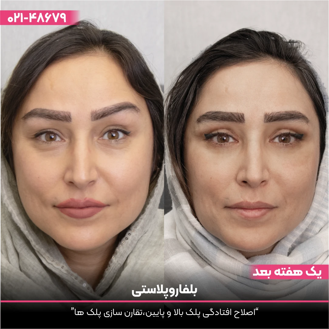 عکس قبل و بعد بلفاروپلاستی