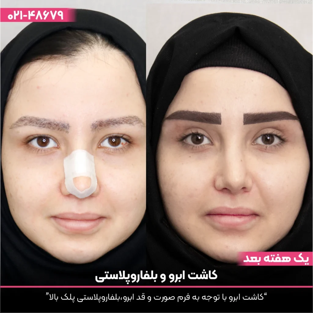 عکس قبل و بعد بلفاروپلاستی دختر
