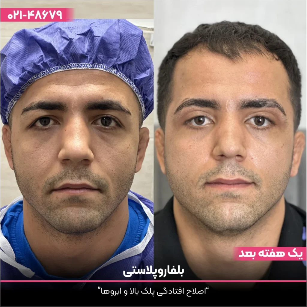 عکس قبل و بعد بلفاروپلاستی مرد