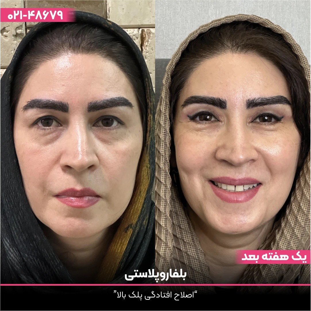 عکس قبل و بعد بلفاروپلاستی زیر چشم خانم