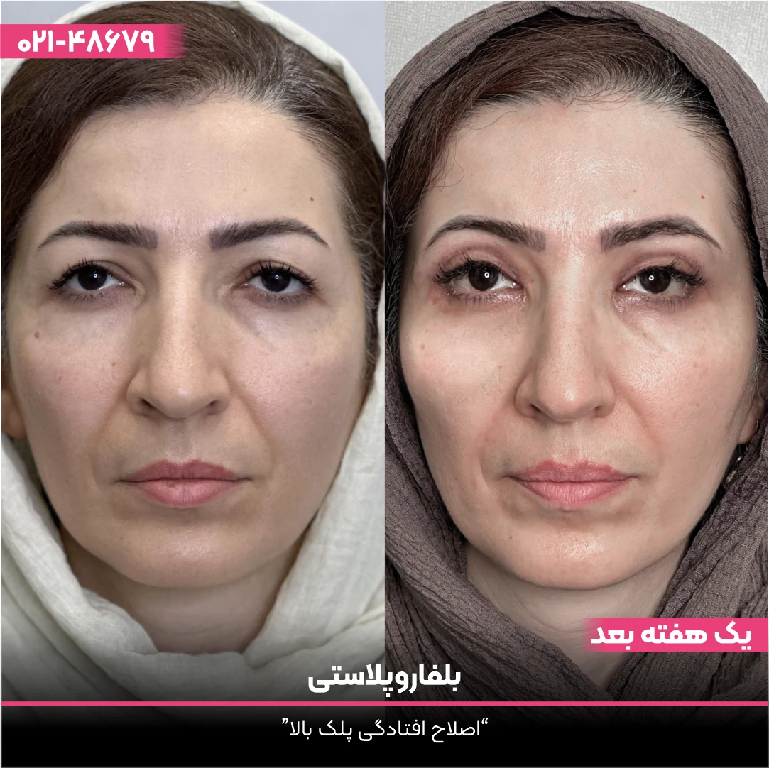 عکس قبل و بعد بلفاروپلاستی