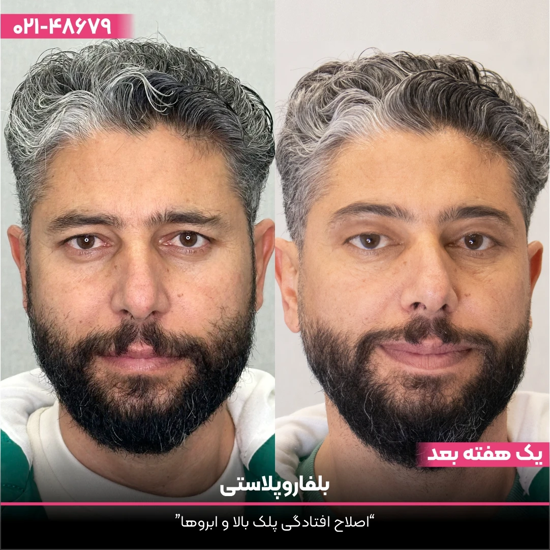 عکس قبل و بعد بلفاروپلاستی مرد با موهای خاکستری