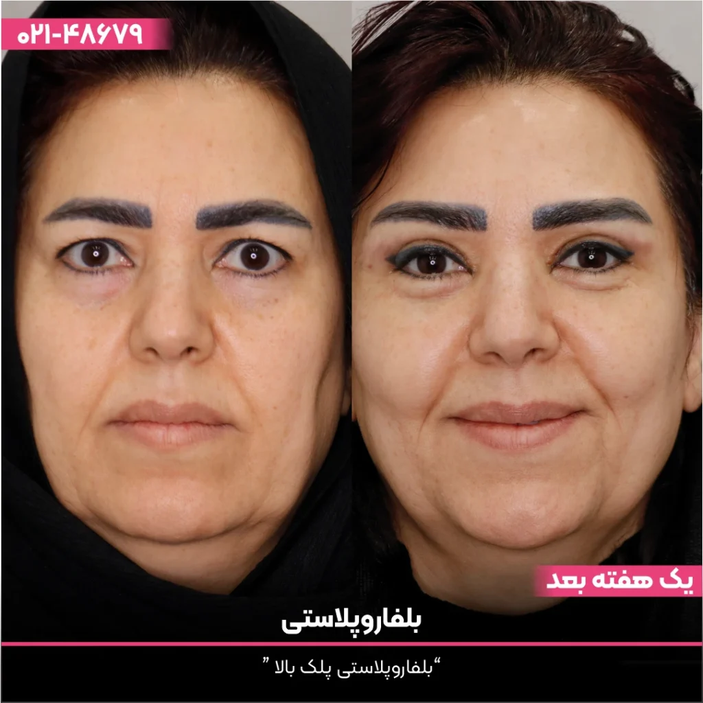 عکس قبل و بعد بلفاروپلاستی خانم با روسری مشکی