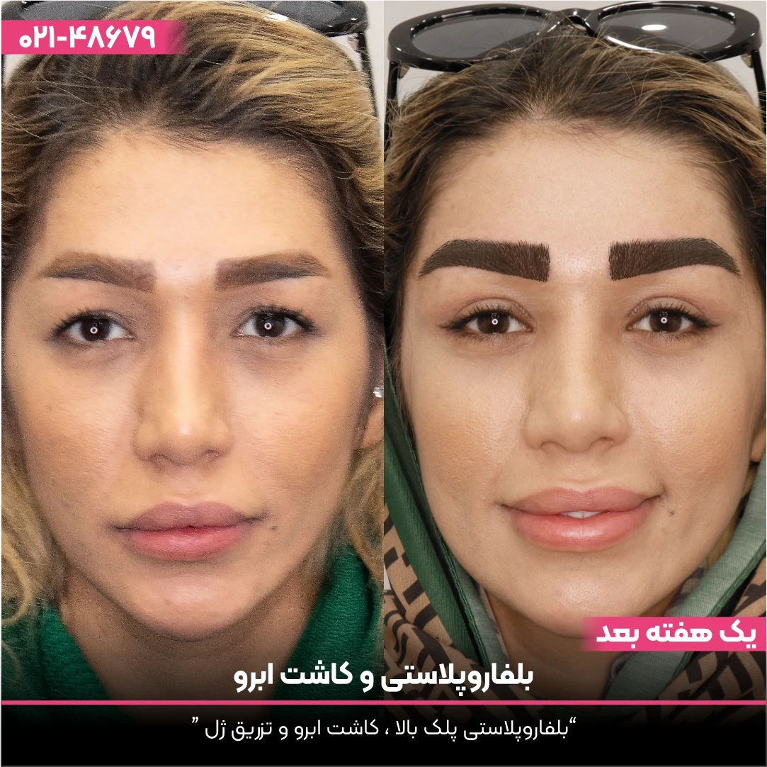 عکس قبل و بعد بلفاروپلاستی چشم دختر