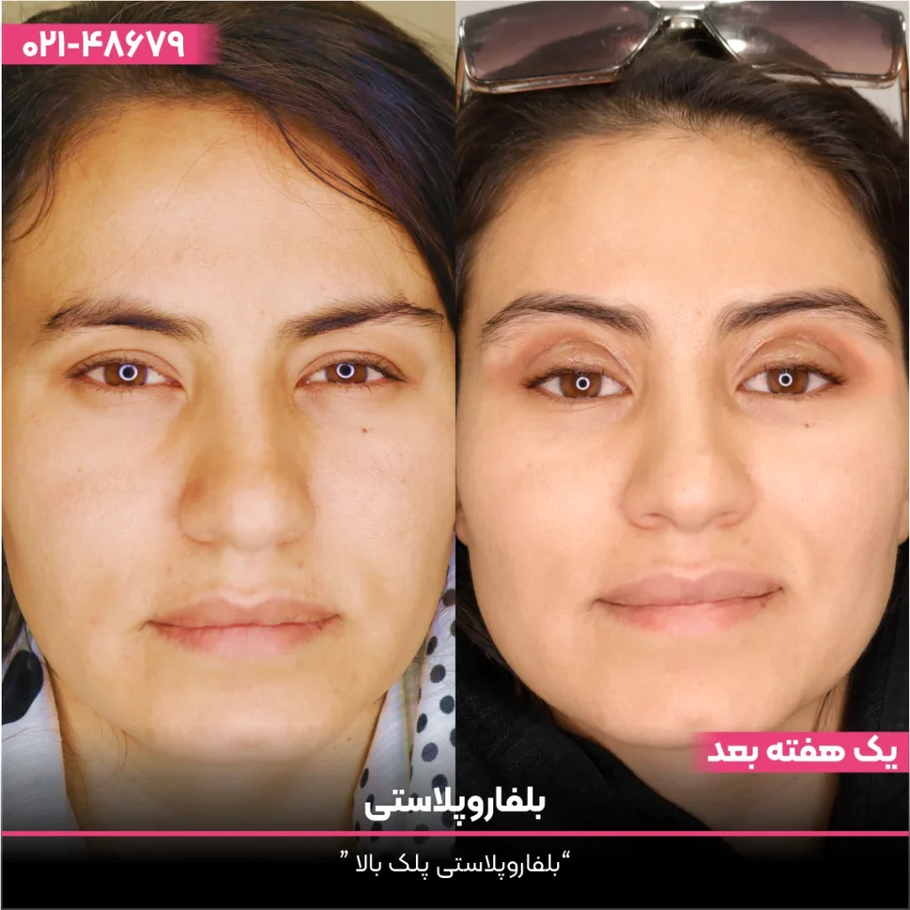 عکس قبل و بعد بلفاروپلاستی دختر