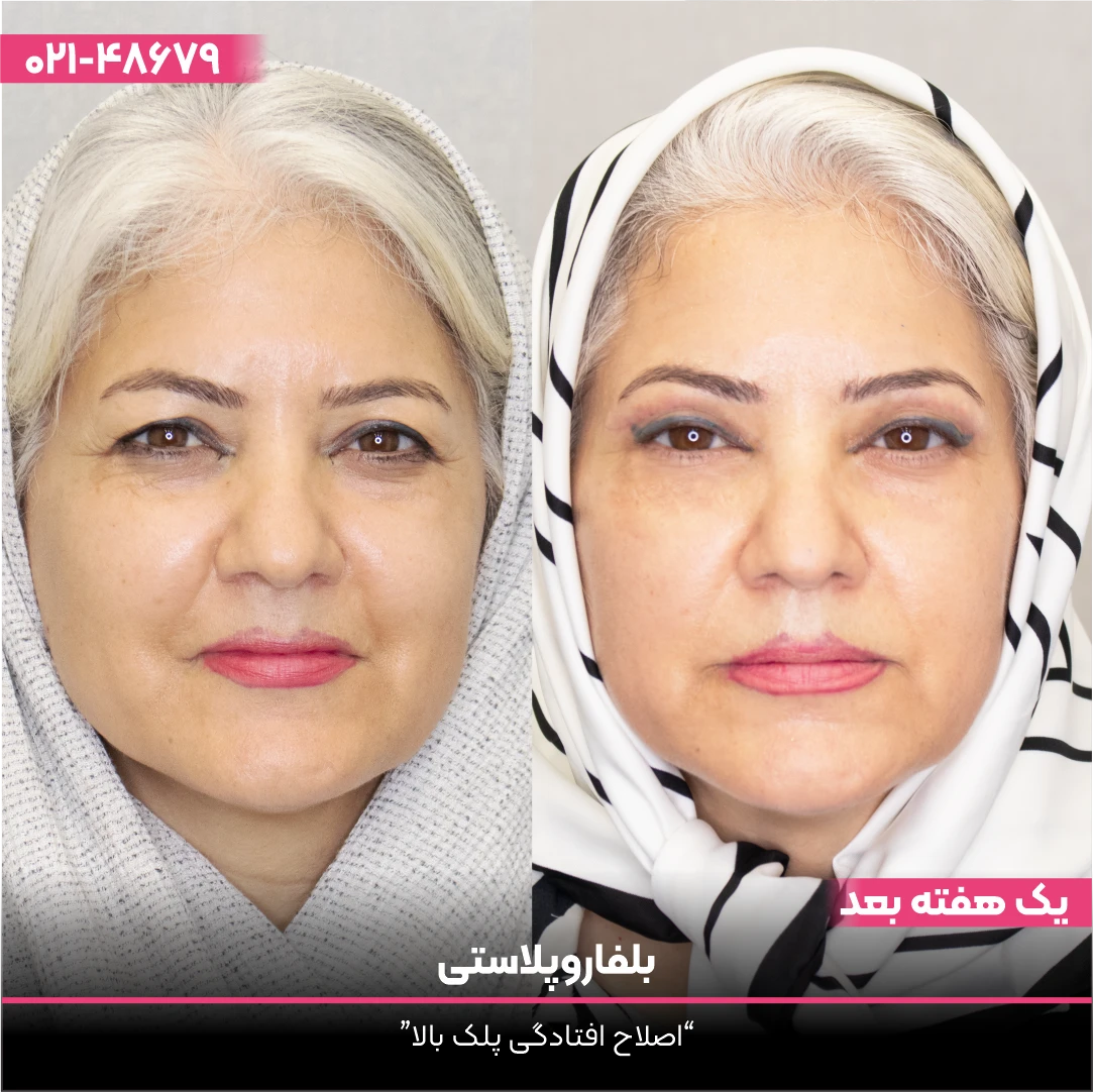 عکس قبل و بعد بلفاروپلاستی خانم مسن