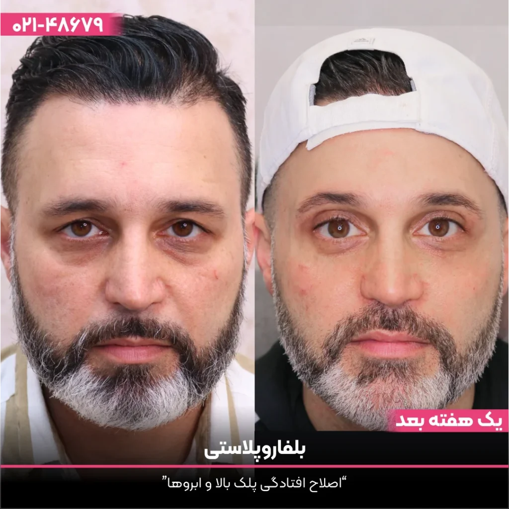 عکس قبل و بعد بلفاروپلاستی آقا که کلاه به سر دارد