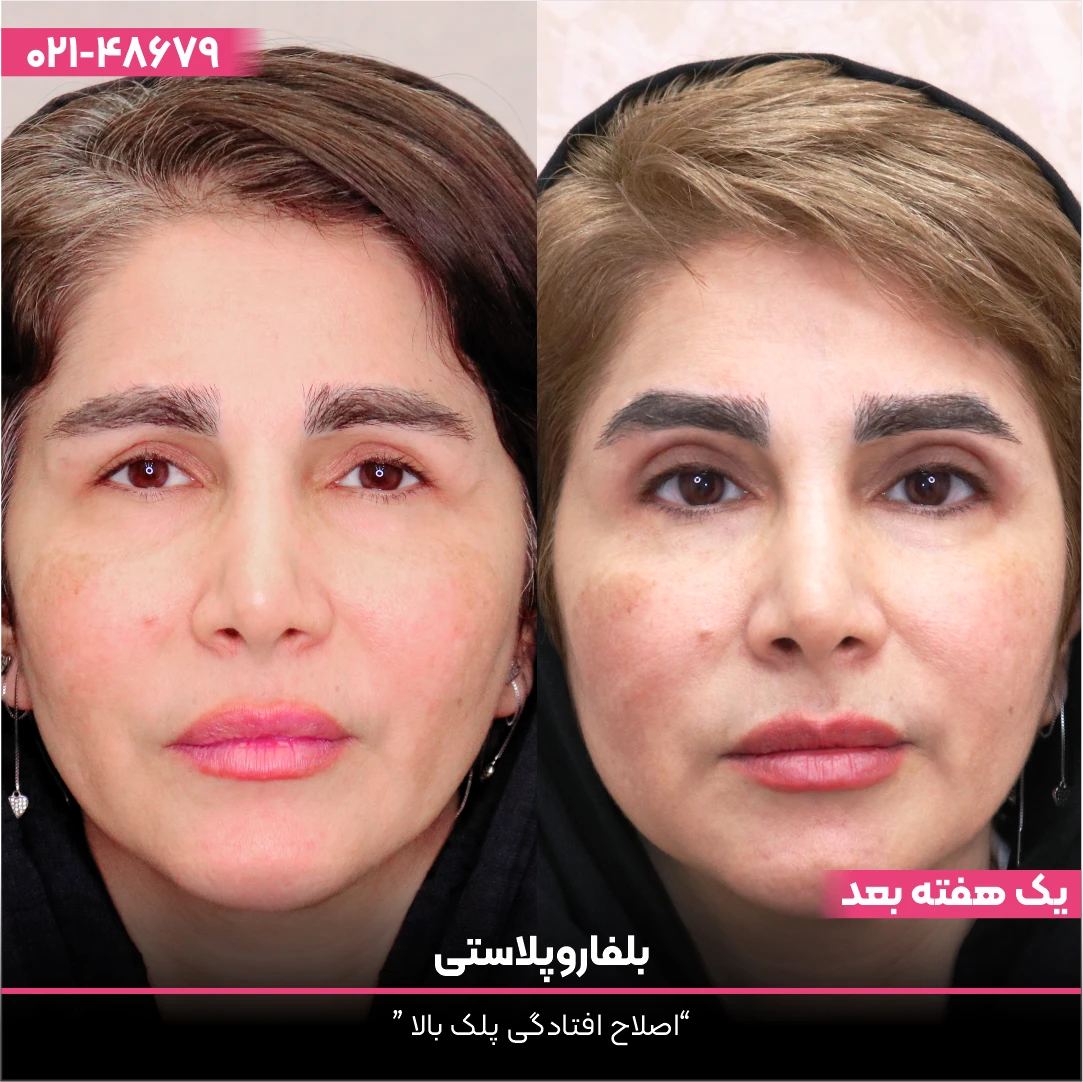 عکس قبل و بعد بلفاروپلاستی دختر
