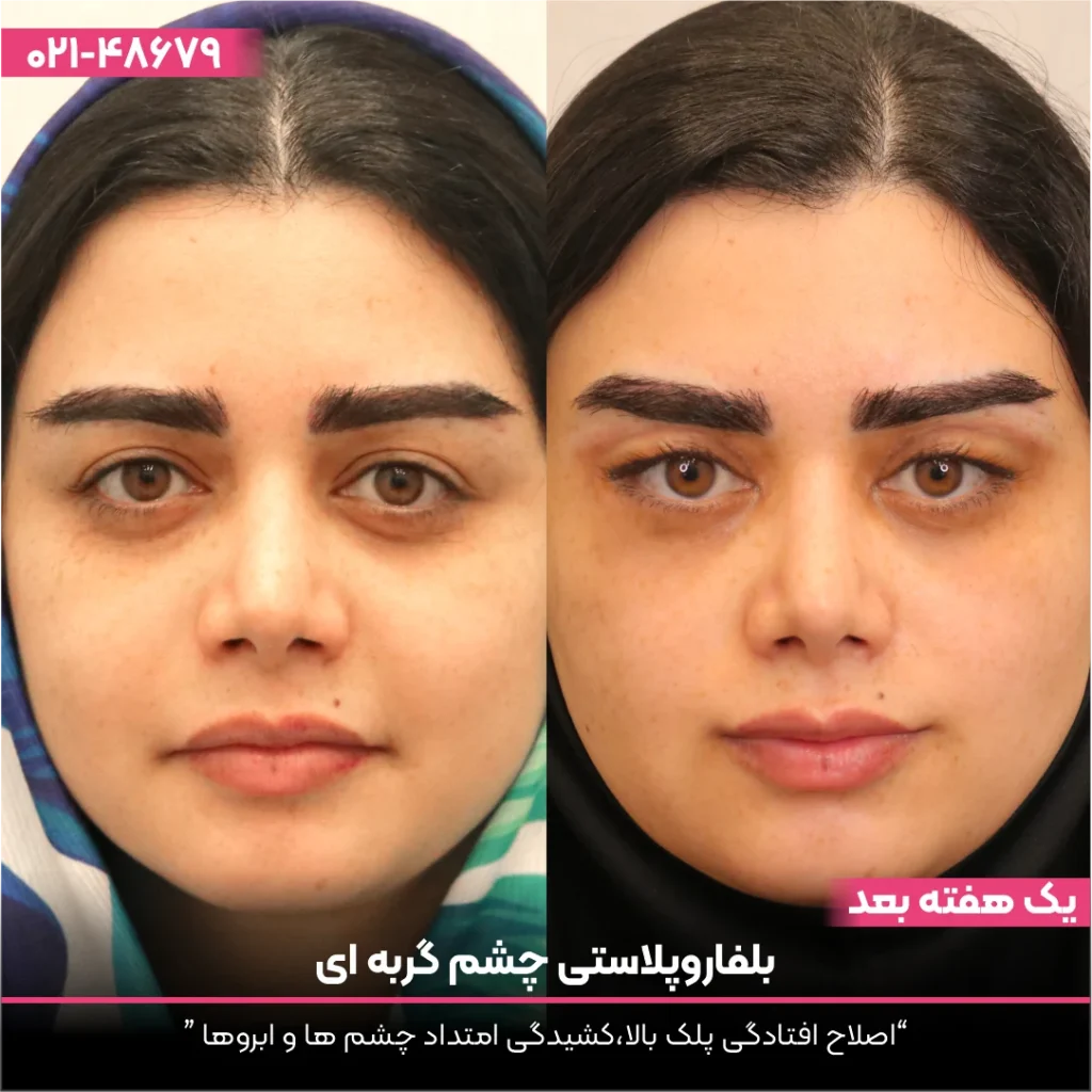 عکس قبل و بعد بلفاروپلاستی دختر جوان