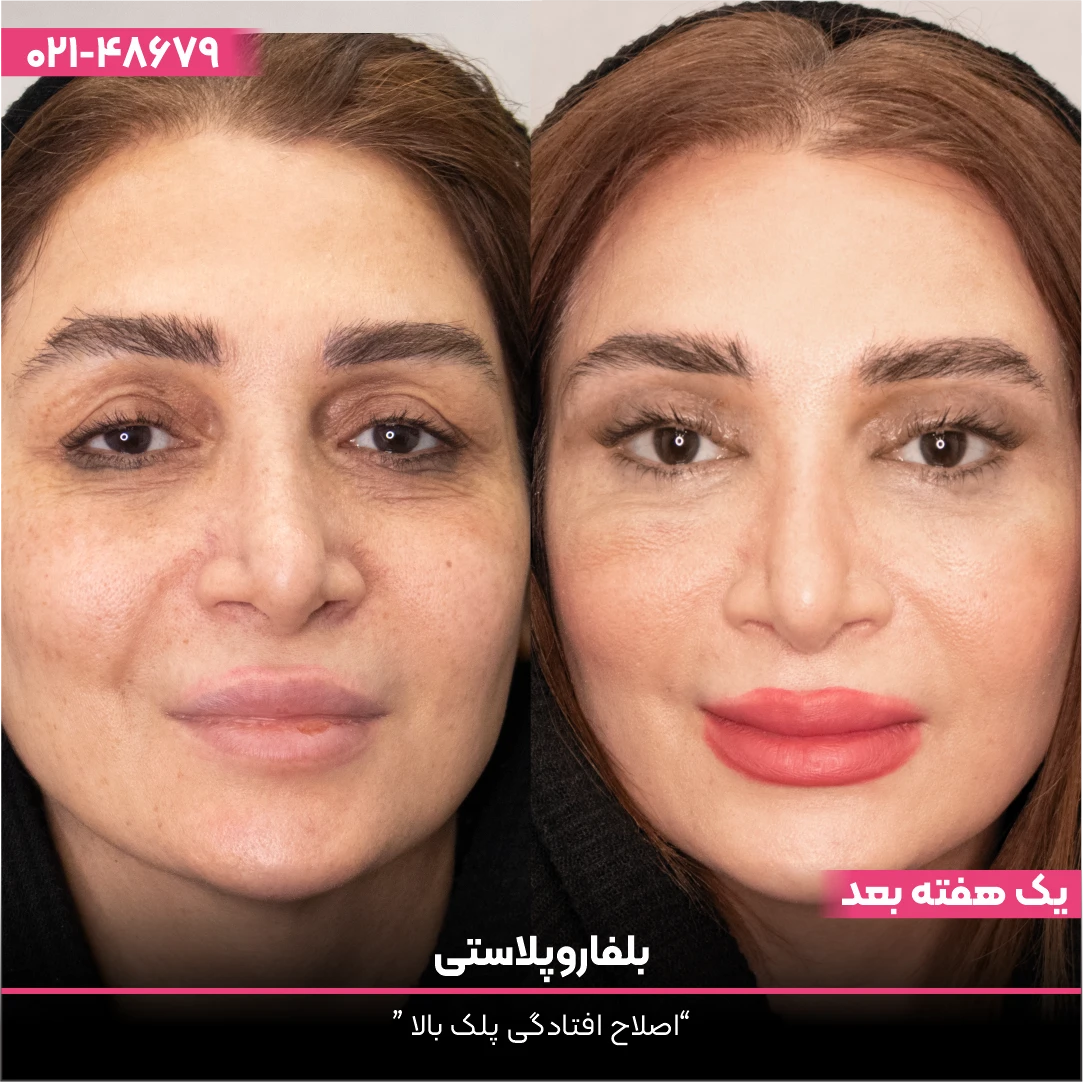 عکس قبل و بعد بلفاروپلاستی چشم های خانم