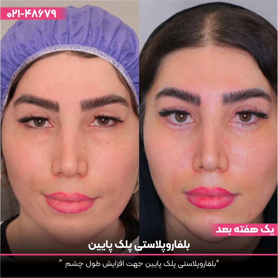 عکس قبل و بعد بلفاروپلاستی زیر چشم دختر
