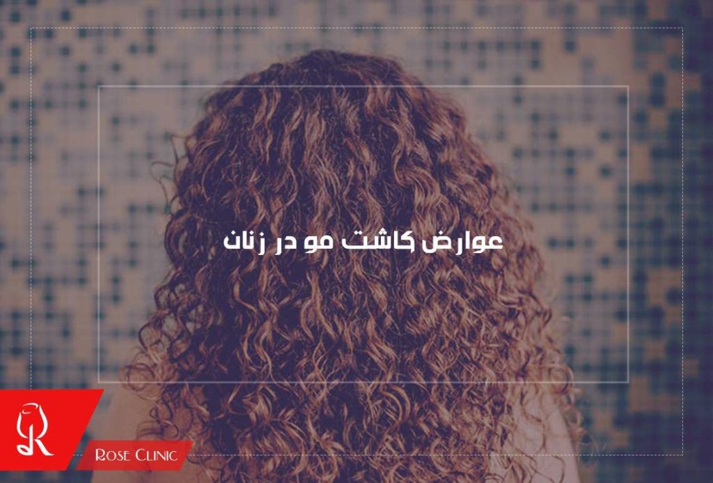 عوارض کاشت مو در زنان