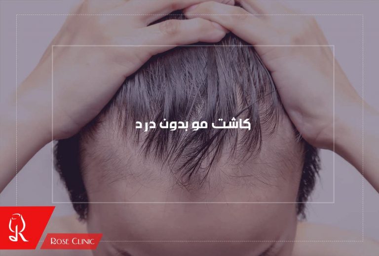 کاشت مو بدون درد