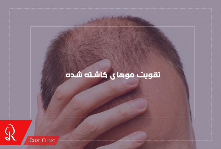 تقویت موهای کاشته شده