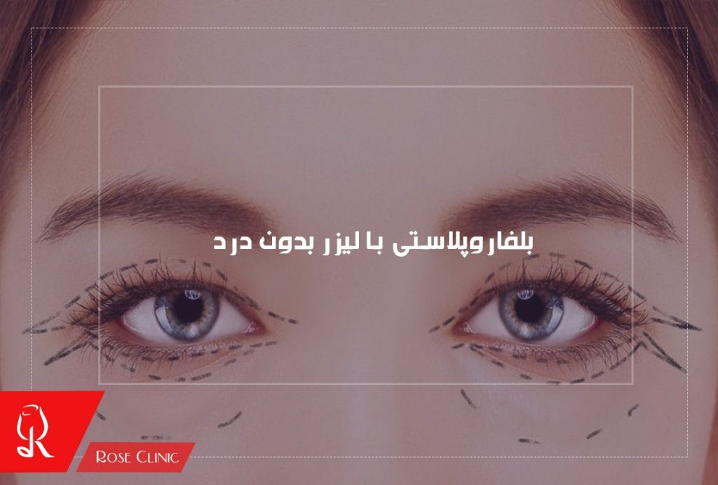 عمل بلفاروپلاستی با لیزر بدون درد و خون ریزی