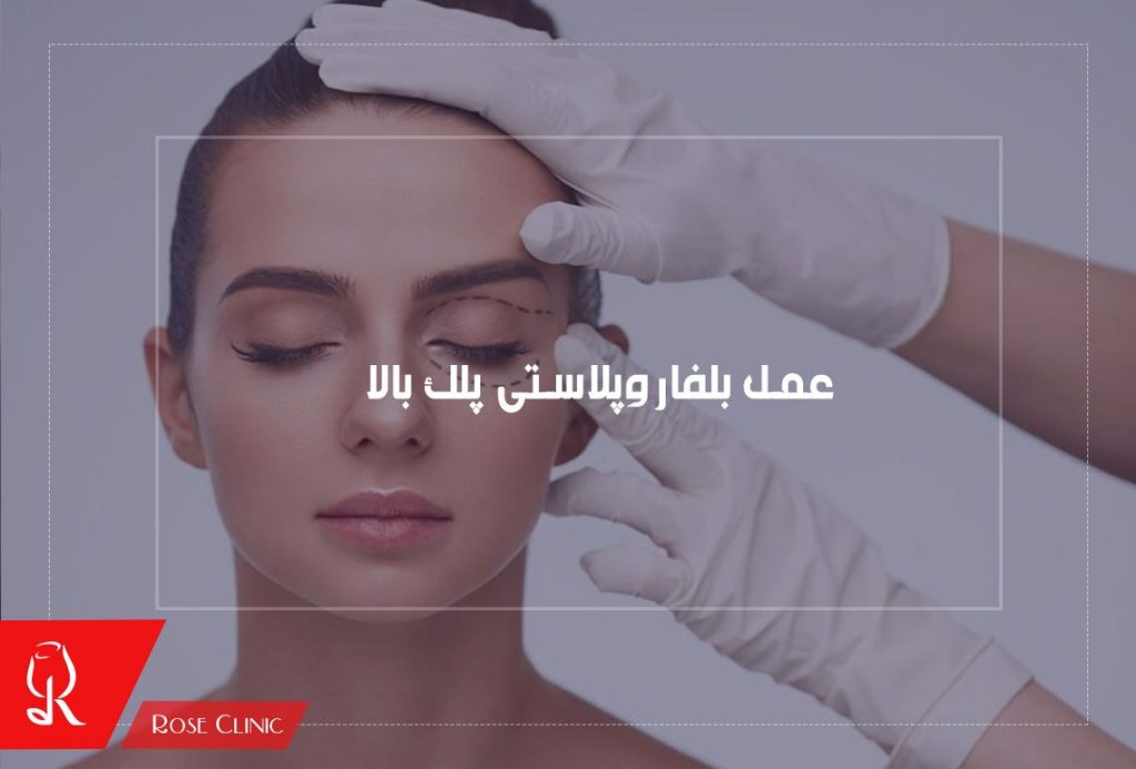 عمل بلفاروپلاستی پلک بالا