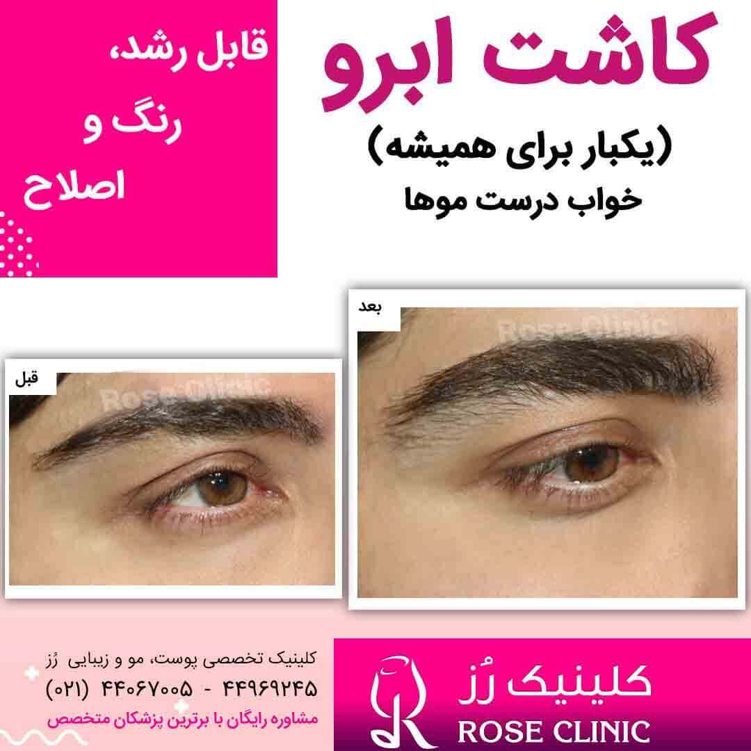 عکس کاشت ابرو 