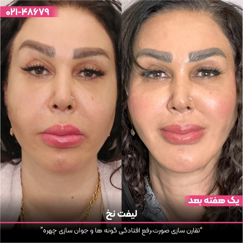 عکس قبل و بعد لیفت با نخ صورت زن