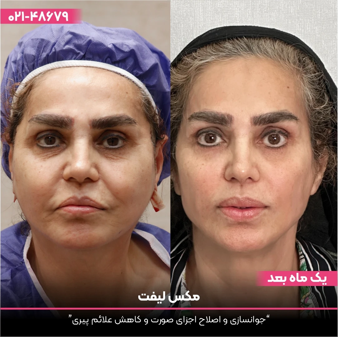 عکس قبل و بعد لیفت نخ صورت خانم