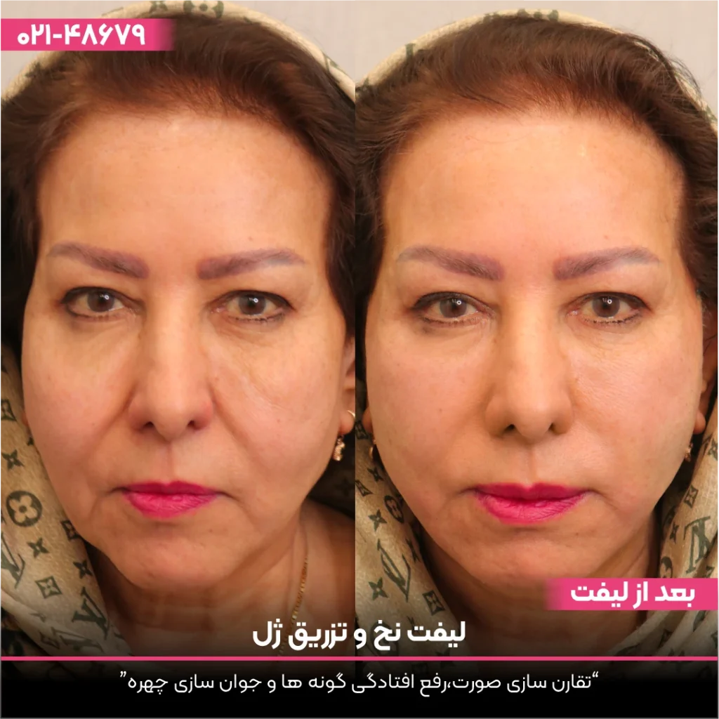 عکس قبل و بعد از خانمی که لیفت با نخ انجام داده است