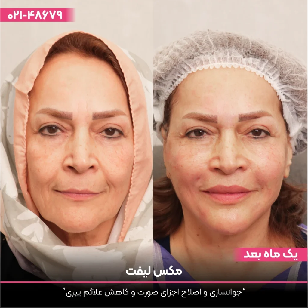 عکس قبل و بعد صورت زن که لیفت با نخ انجام داده است