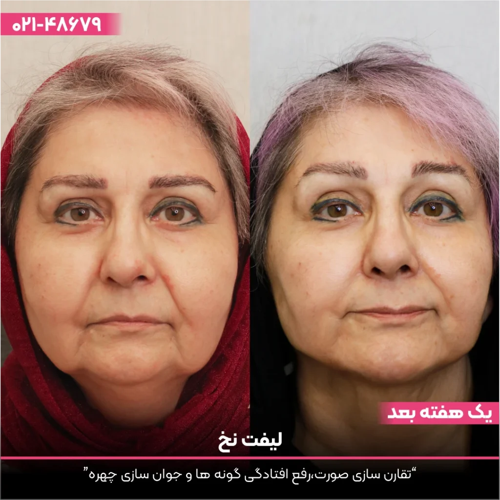 تصویر قبل و بعد چهره خانمی که لیفت با نخ انجام داده است