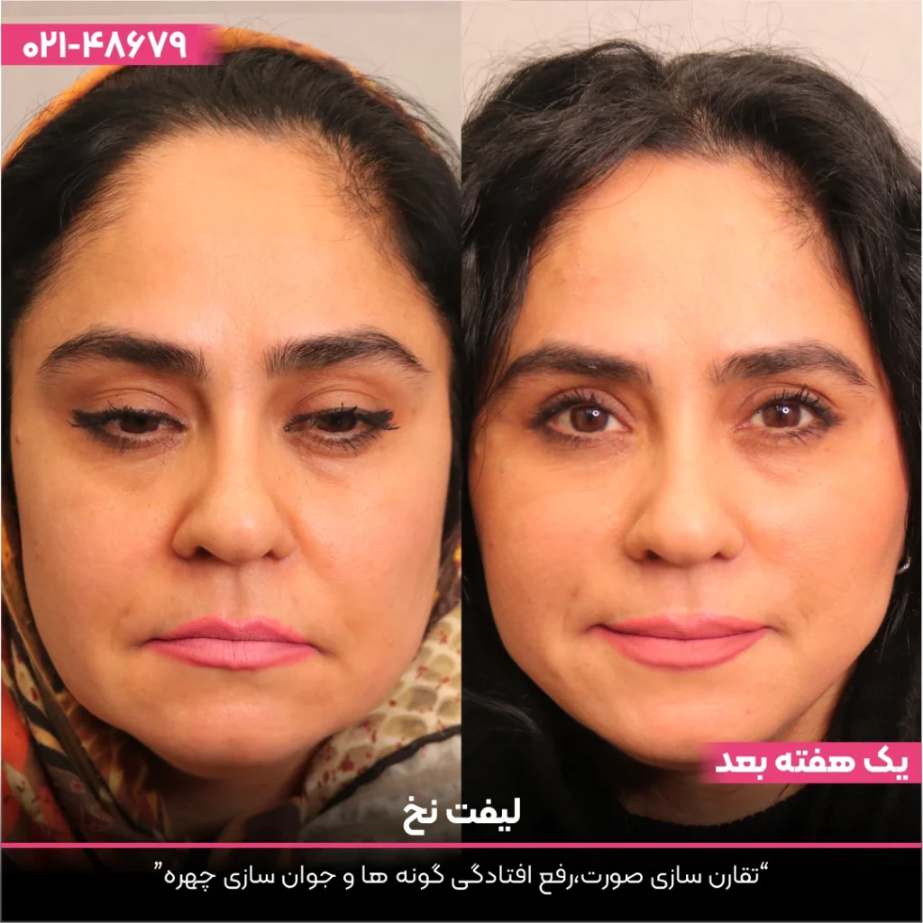 عکس قبل و بعد از صورت خانمی که لیفت صورت با نخ انجام داده است
