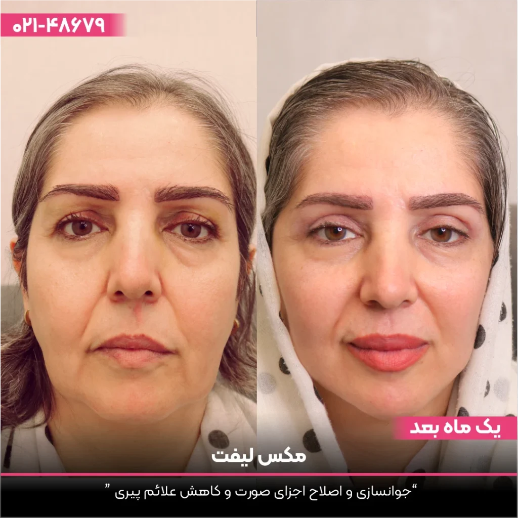 عکس قبل و بعد لیفت صورت زن با نخ - لیفت با نخ