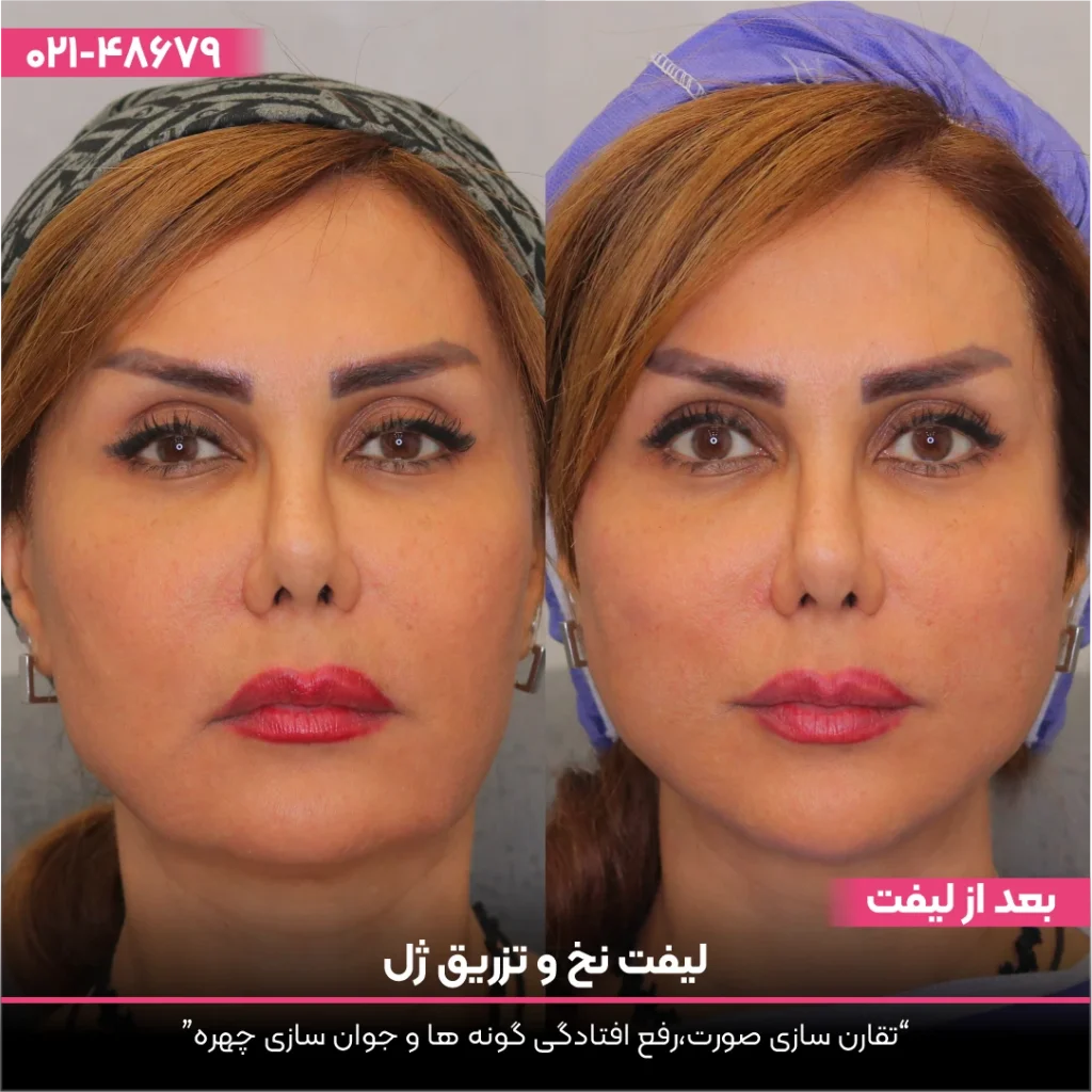 عکس قبل و بعد از خانمی که لیفت صورت با نخ انجام داده است