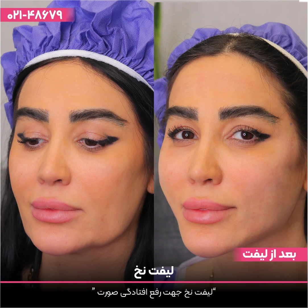 عکس قبل و بعد لیفت نخ صورت دختر