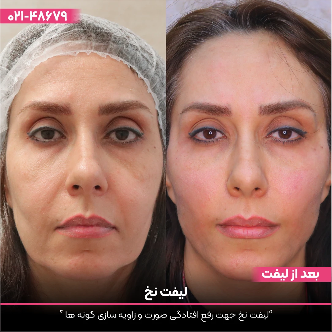 عکس قبل و بعد از صورت خانم که لیفت نخ انجام داده