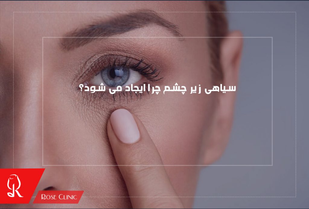سیاهی زیر چشم چرا ایجاد می شود؟