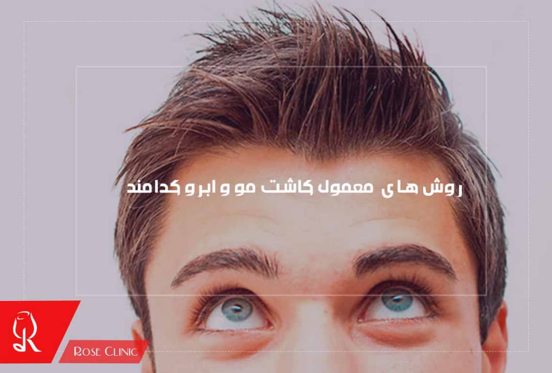 روش های معمول کاشت مو و ابرو کدامند؟
