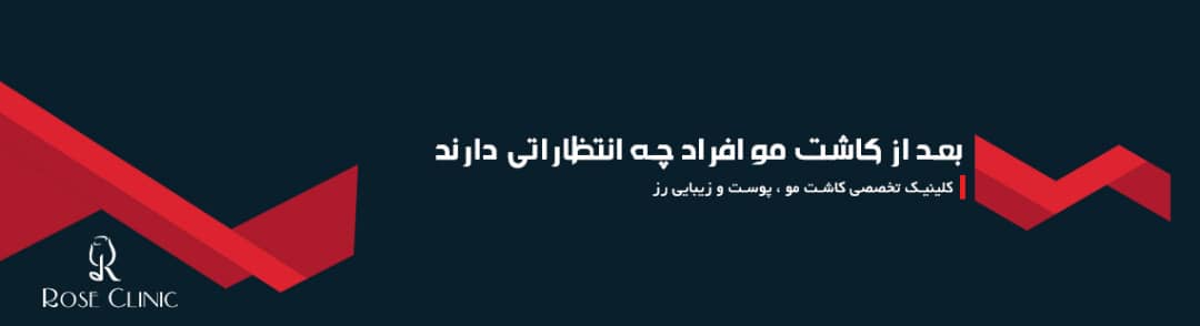 بعد از کاشت مو افراد چه انتظاراتی دارند؟