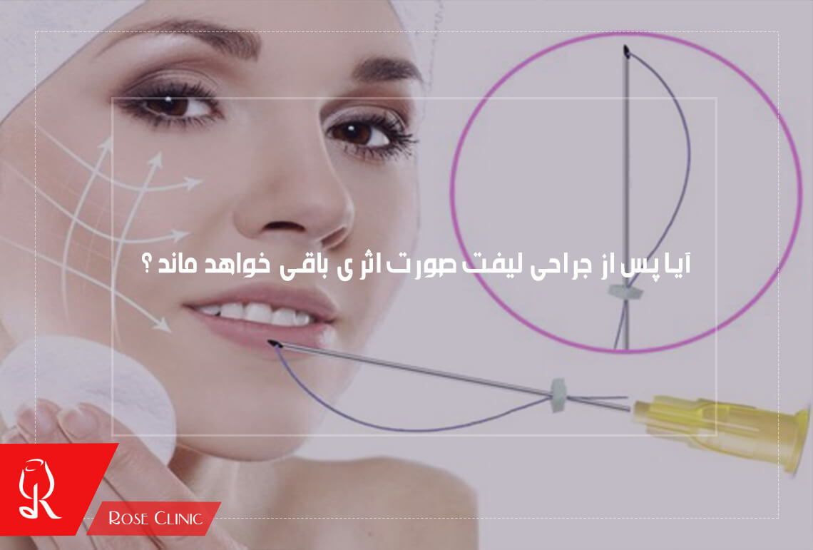 آیا پس از جراحی لیفت صورت اثری باقی خواهد ماند