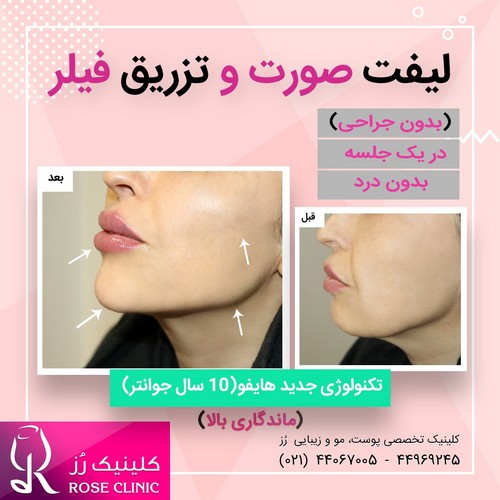 عکس لیفت صورت