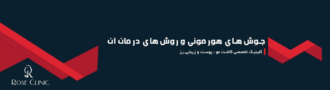 جوش های هورمونی و روش های درمان آن
