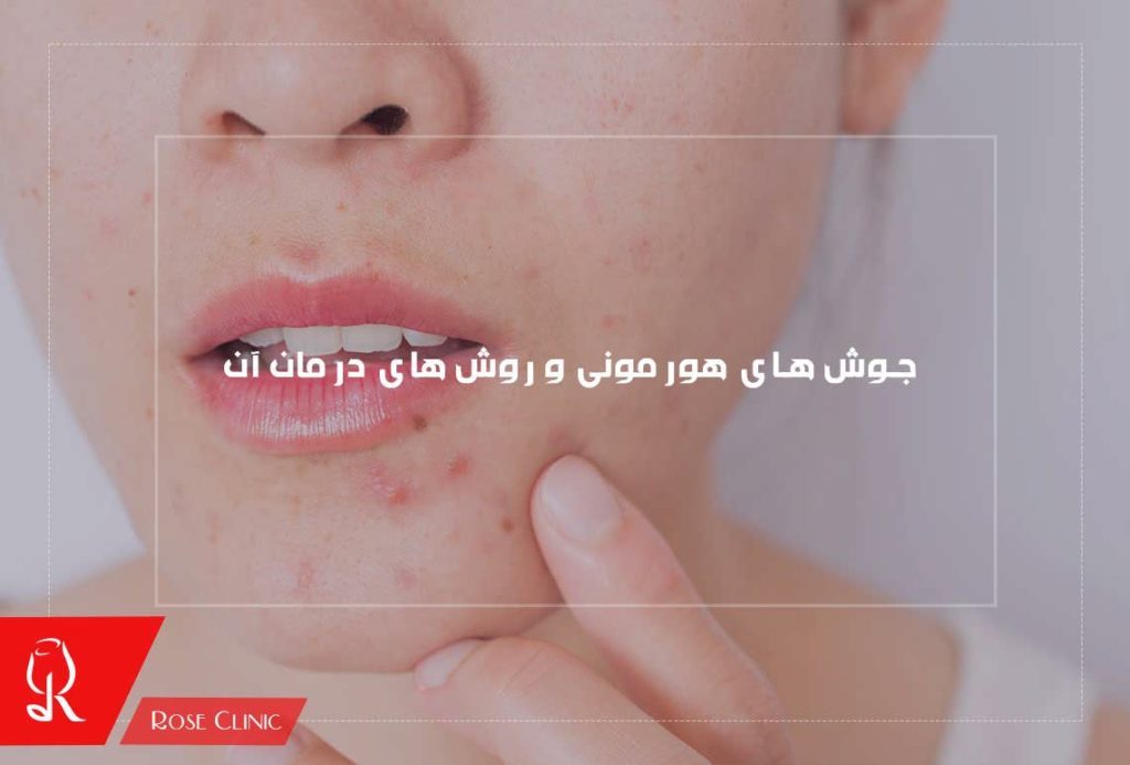 جوش های هورمونی و روش های درمان آن