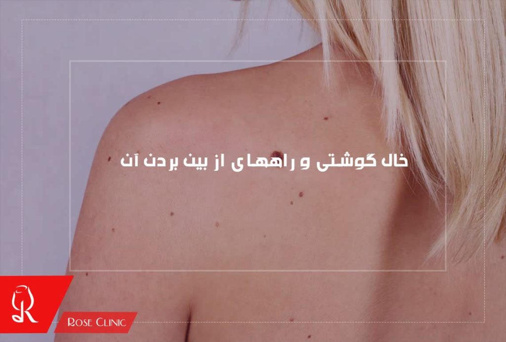 خال گوشتی و راههای از بین بردن آن