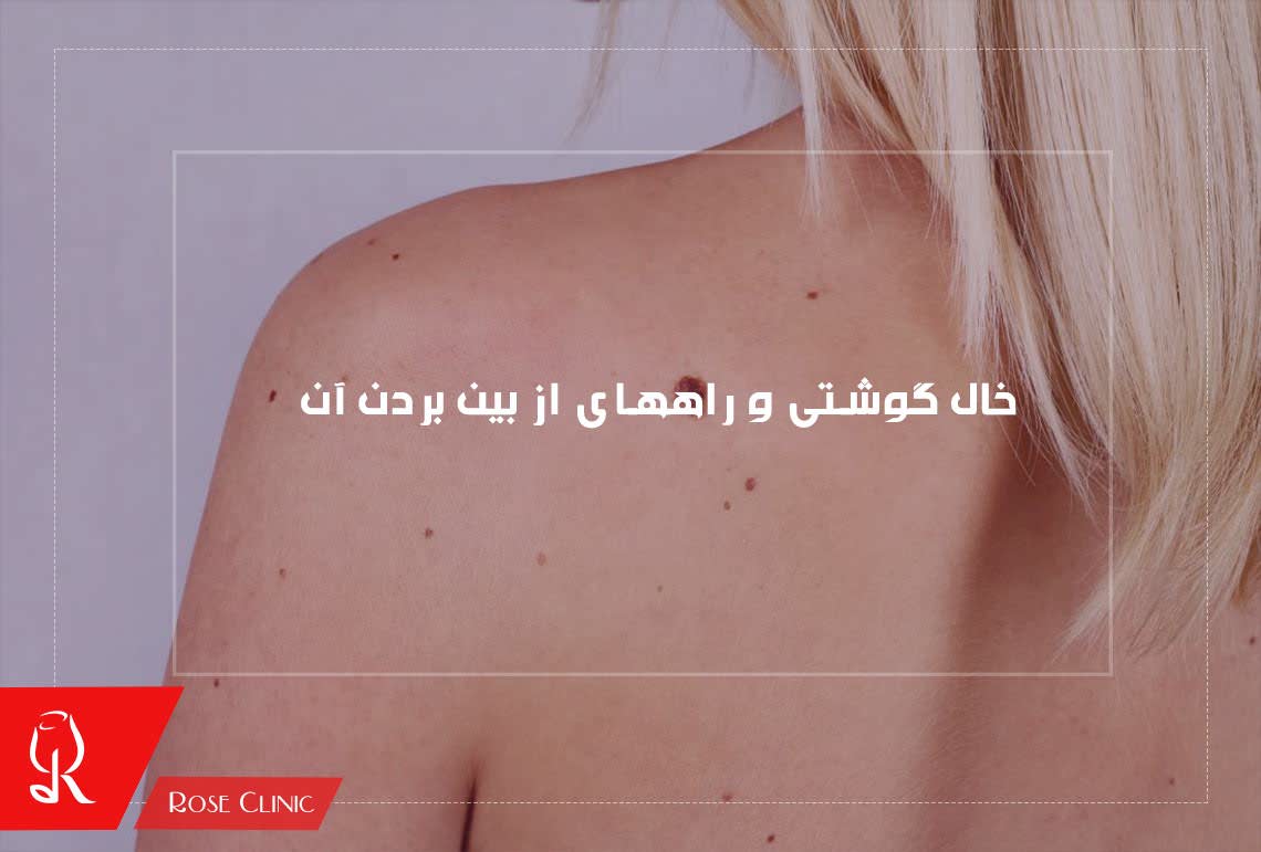 خال گوشتی و راههای از بین بردن آن 