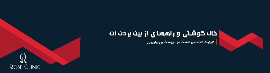 خال گوشتی و راههای از بین بردن آن 