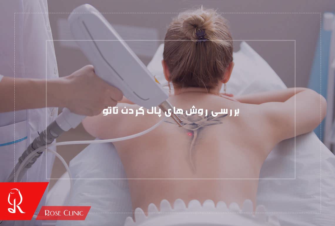 بررسی روش های پاک کردن تاتو