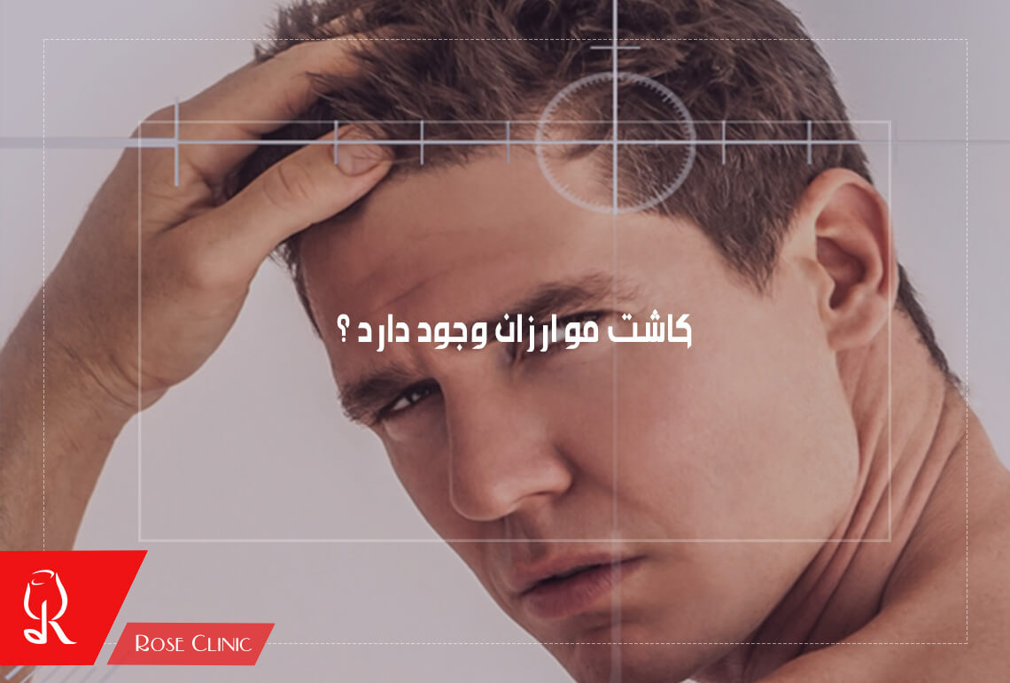 کاشت مو ارزان وجود دارد