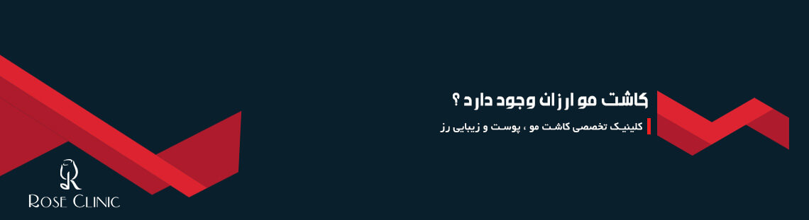 کاشت مو ارزان وجود دارد