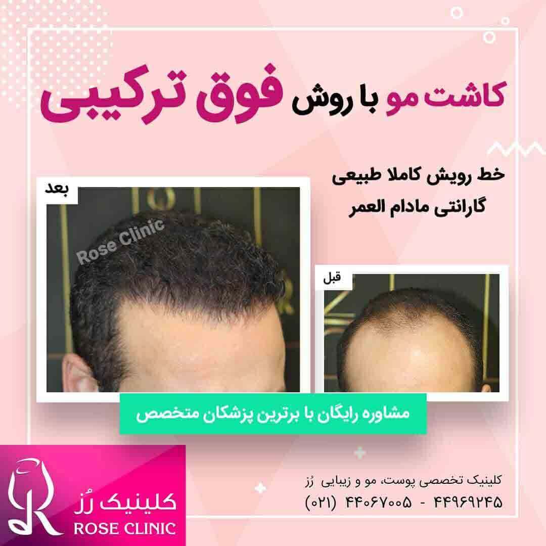 عکس کاشت مو