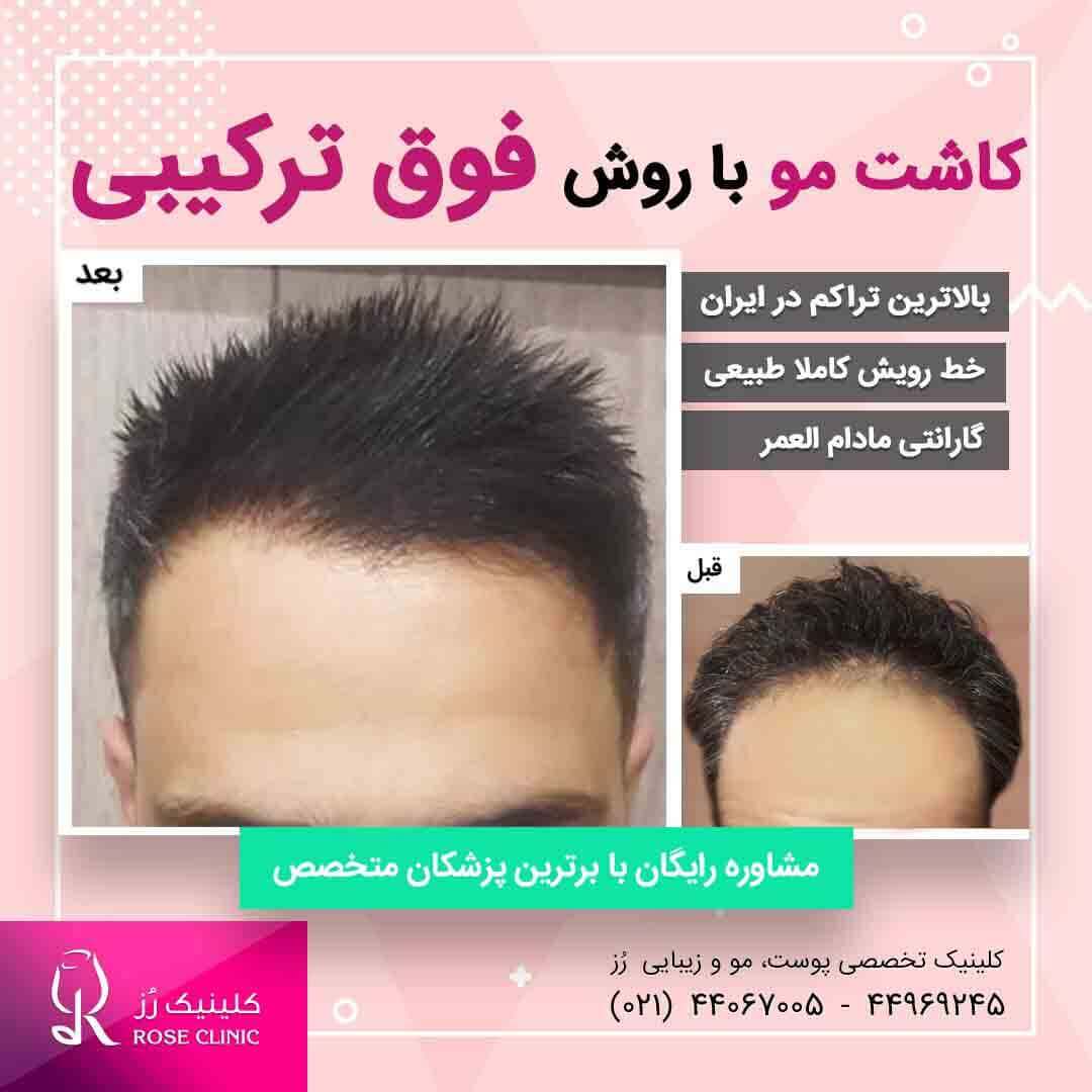 عکس کاشت مو