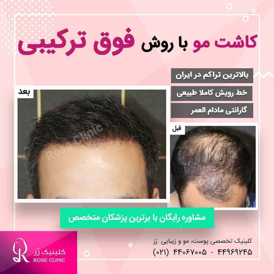 عکس کاشت مو 