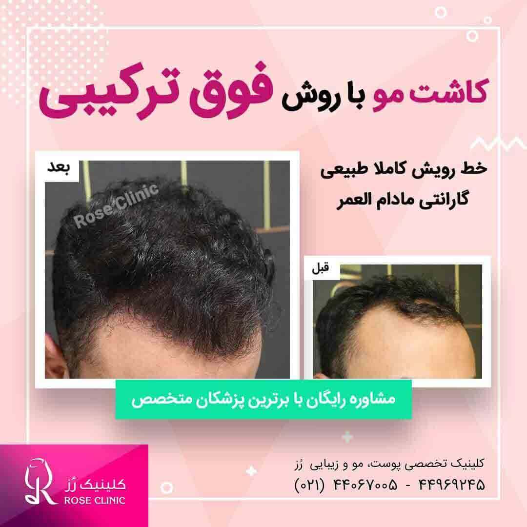 عکس کاشت مو