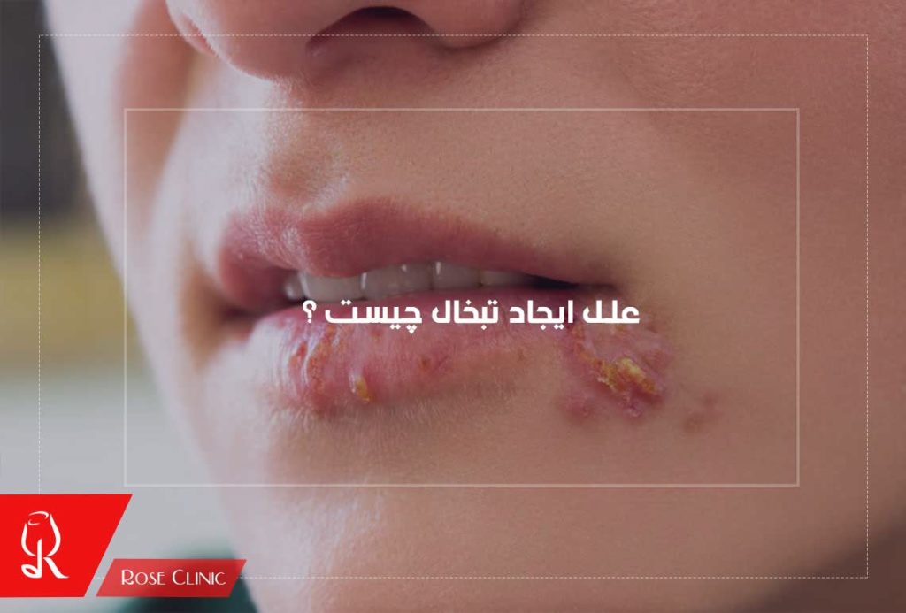 علل ایجاد تبخال چیست ؟